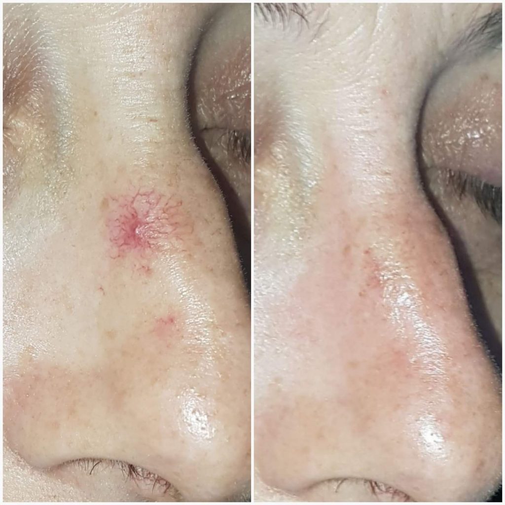 Spider vein removed at Kumiega Skin Care Clnic