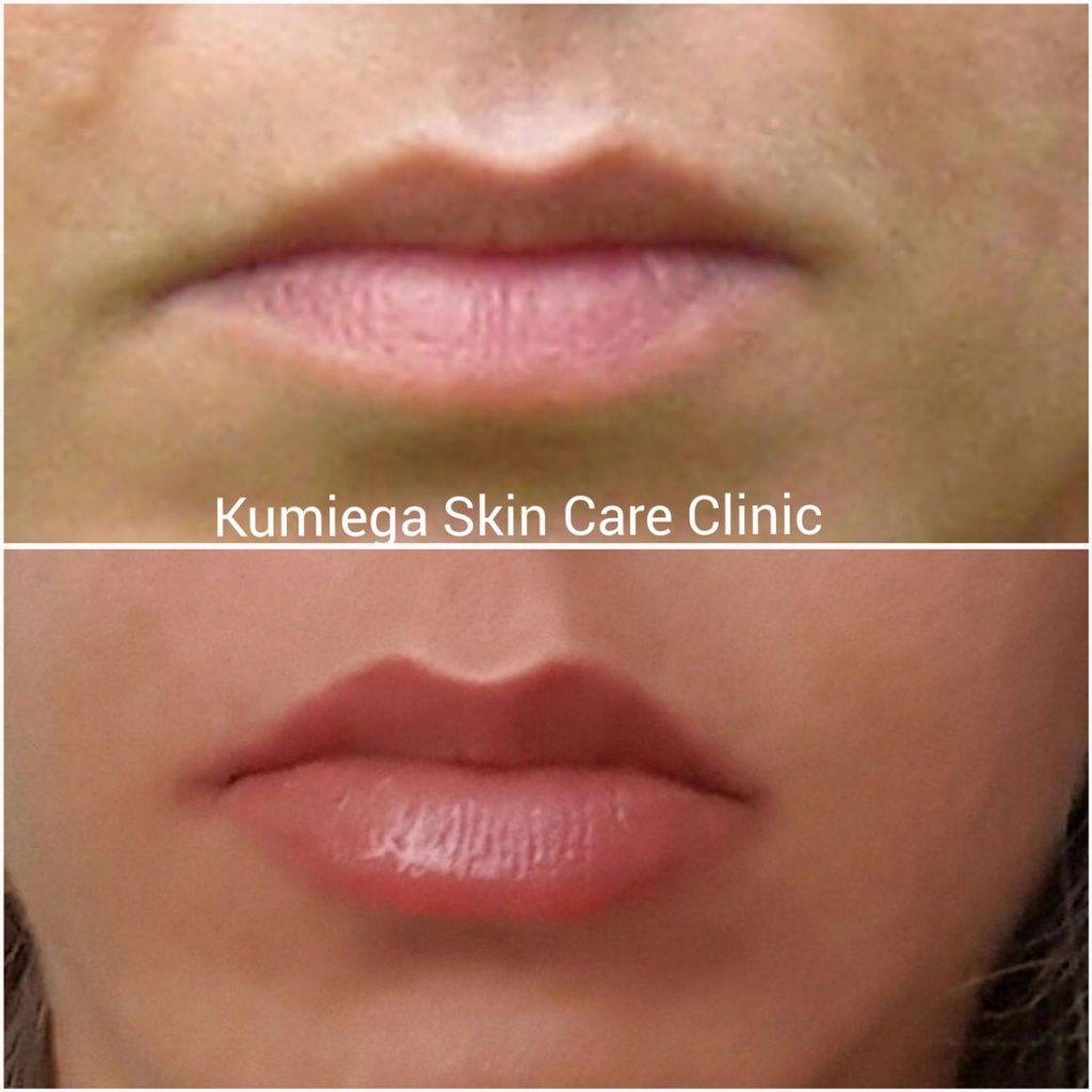 Lip augmentation performed at Kumiega Skin care Clinic