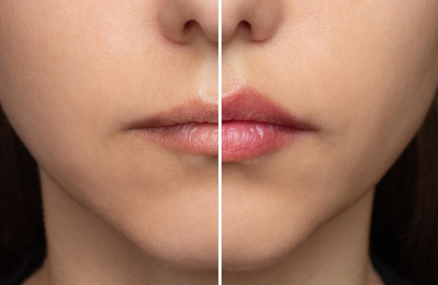 Lip Rejuvenation